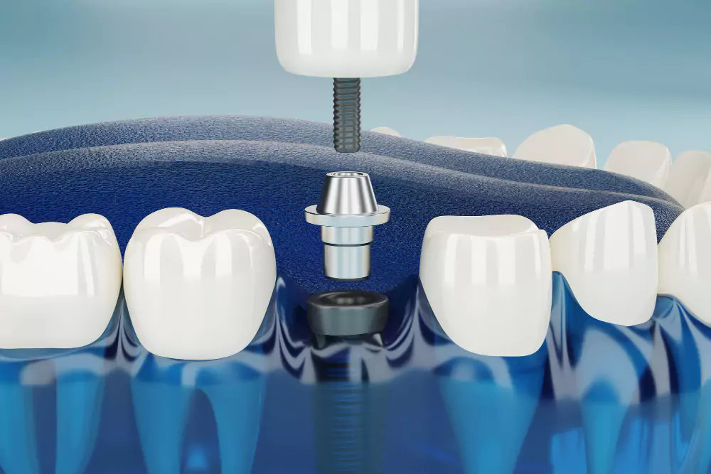 Dental Implants & Minor Oral Surgeries